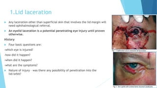 1.Lid laceration
 Any laceration other than superficial skin that involves the lid margin will
need ophthalmological referral.
 An eyelid laceration is a potential penetrating eye injury until proven
otherwise.
History
 Four basic questions are:
-which eye is injured?
-how did it happen?
-when did it happen?
-what are the symptoms?
 Nature of injury – was there any possibility of penetration into the
lid/orbit?
 