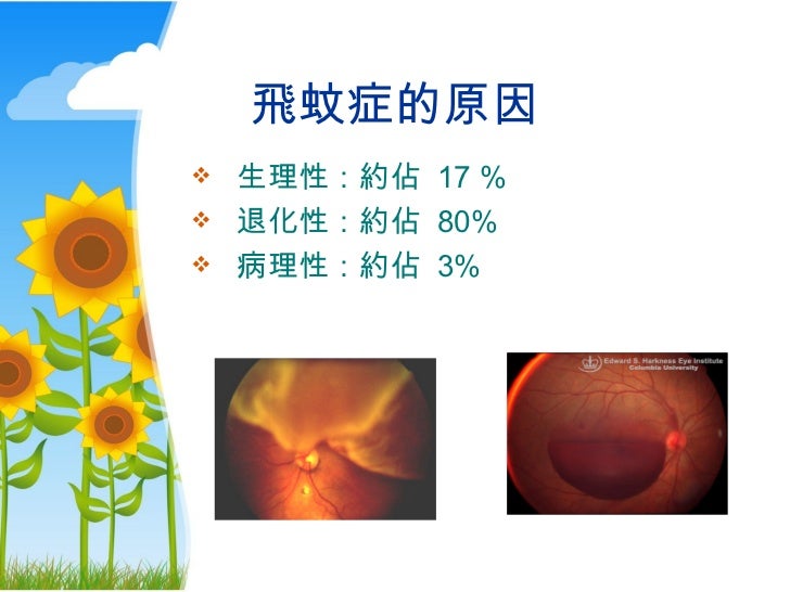 Eye floaters laser treatment