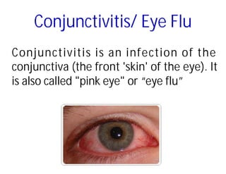 Conjunctivitis/ Eye Flu
Conjunctivitis is an infection of the
conjunctiva (the front 'skin' of the eye). It
is also called "pink eye" or “eye flu”
 