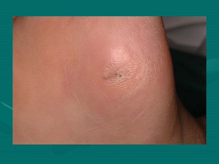 EyeFoot Syndrome Case History