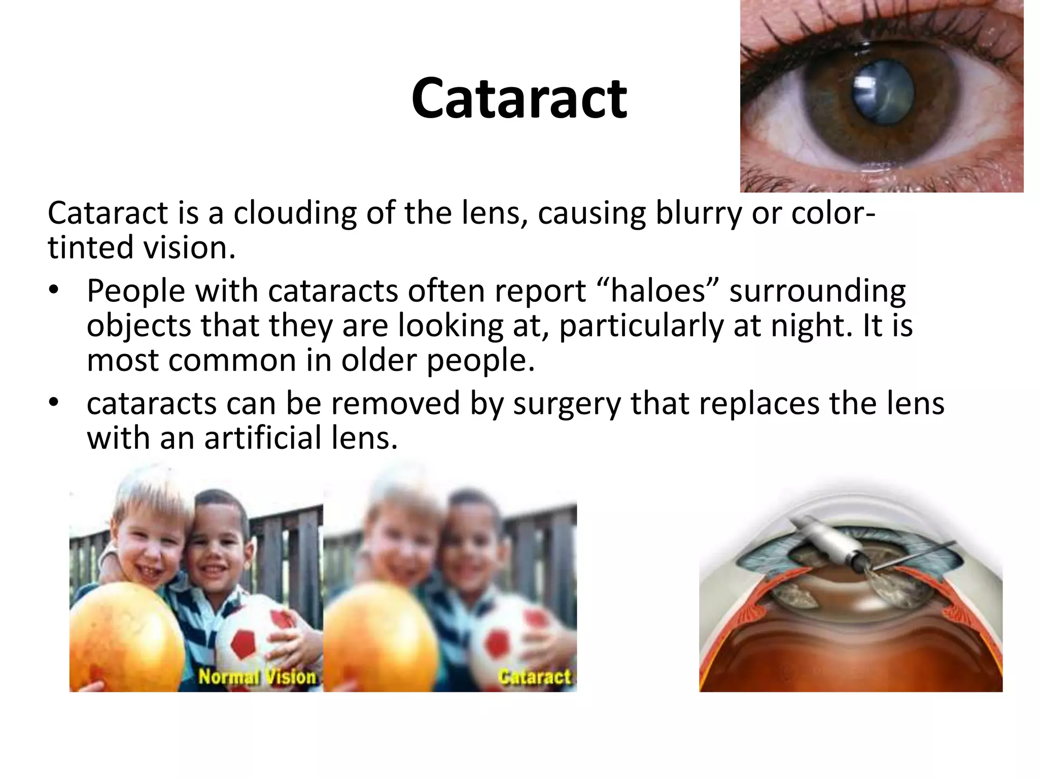 Cataract
Cataract is a clouding of the lens, causing blurry or color-
tinted vision.
• People with cataracts often report “haloes” surrounding
objects that they are looking at, particularly at night. It is
most common in older people.
• cataracts can be removed by surgery that replaces the lens
with an artificial lens.
 