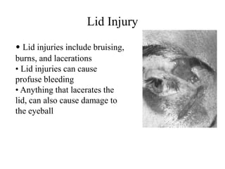 Lid Injury
• Lid injuries include bruising,
burns, and lacerations
• Lid injuries can cause
profuse bleeding
• Anything that lacerates the
lid, can also cause damage to
the eyeball
 