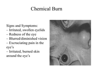 Chemical Burn
Signs and Symptoms:
– Irritated, swollen eyelids
– Redness of the eye
– Blurred/diminished vision
– Excruciating pain in the
eye’s
– Irritated, burned skin
around the eye’s
 