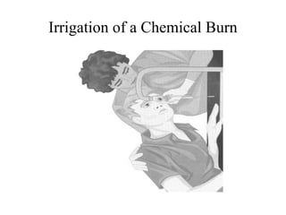 Irrigation of a Chemical Burn
 