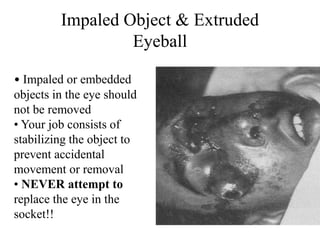 Impaled Object & Extruded
Eyeball
• Impaled or embedded
objects in the eye should
not be removed
• Your job consists of
stabilizing the object to
prevent accidental
movement or removal
• NEVER attempt to
replace the eye in the
socket!!
 