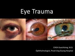 Eye Trauma
CHEA Guechlaing, M.D.
Ophthalmologist, Preah Ang Duong Hospital
 