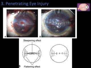 Eye injuries.pdfhhhhhhhhhhhhhhhhhhhhhhhh | PDF