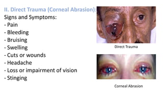 II. Direct Trauma (Corneal Abrasion):
Signs and Symptoms:
- Pain
- Bleeding
- Bruising
- Swelling
- Cuts or wounds
- Headache
- Loss or impairment of vision
- Stinging
Corneal Abrasion
Direct Trauma
 