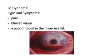 IV. Hyphema:
Signs and Symptoms:
‐ pain
‐ blurred vision
‐ a pool of blood in the lower eye lid.
 