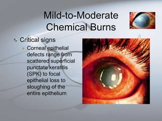 Eye injuries and illnesses- Third year mbbs Ophthalmology | PPTX