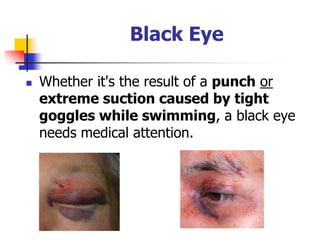 Eye Injury | PDF