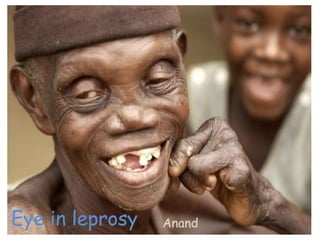 Eye in leprosy Anand
 