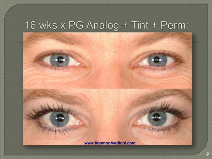 Lumigan For Eyelash Growth Side Effects