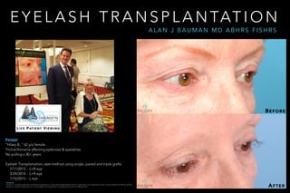 E Y E L A S H T R A N S P L A N TAT I O N
A L A N J B A U M A N M D A B H R S F I S H R S
PATIENT
“Hilary B.,” 62 y/o fema...