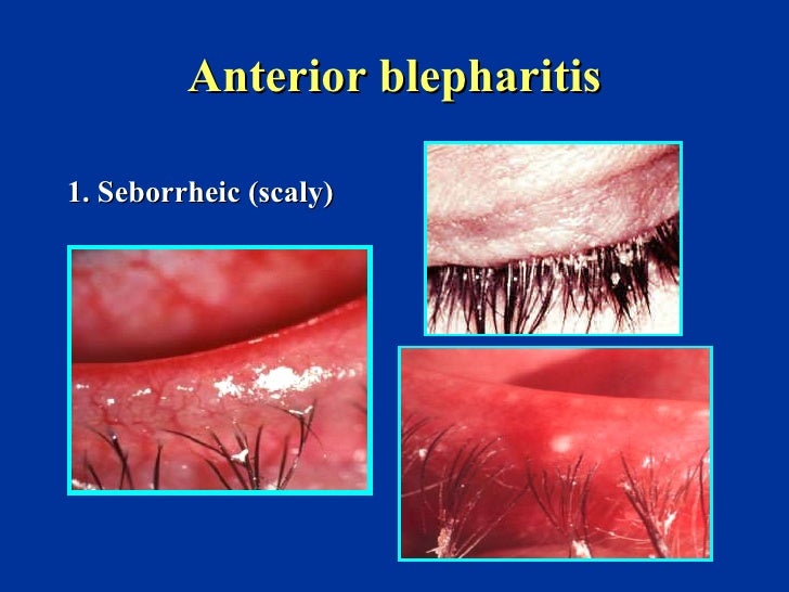  Draw A Sketch To Describe Blepharitis for Girl