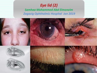 Eye lid (2)
Samhaa Mohammed Abd Elmoneim
Zagazig Ophthalmic Hospital Jan 2019
 