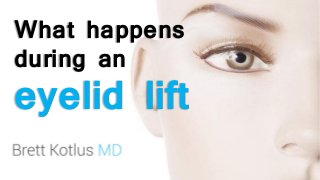 What happens
during an
eyelid lift
 