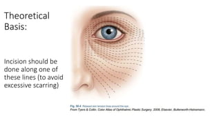 Theoretical
Basis:
Incision should be
done along one of
these lines (to avoid
excessive scarring)
 