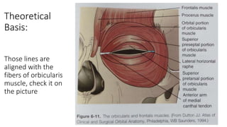 Theoretical
Basis:
Those lines are
aligned with the
fibers of orbicularis
muscle, check it on
the picture
 