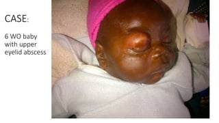CASE:
6 WO baby
with upper
eyelid abscess
 