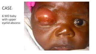 CASE:
6 WO baby
with upper
eyelid abscess
 
