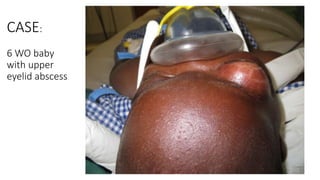 CASE:
6 WO baby
with upper
eyelid abscess
 