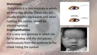 Diseases of eyelid.pptx