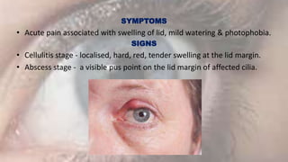 Diseases of eyelid.pptx