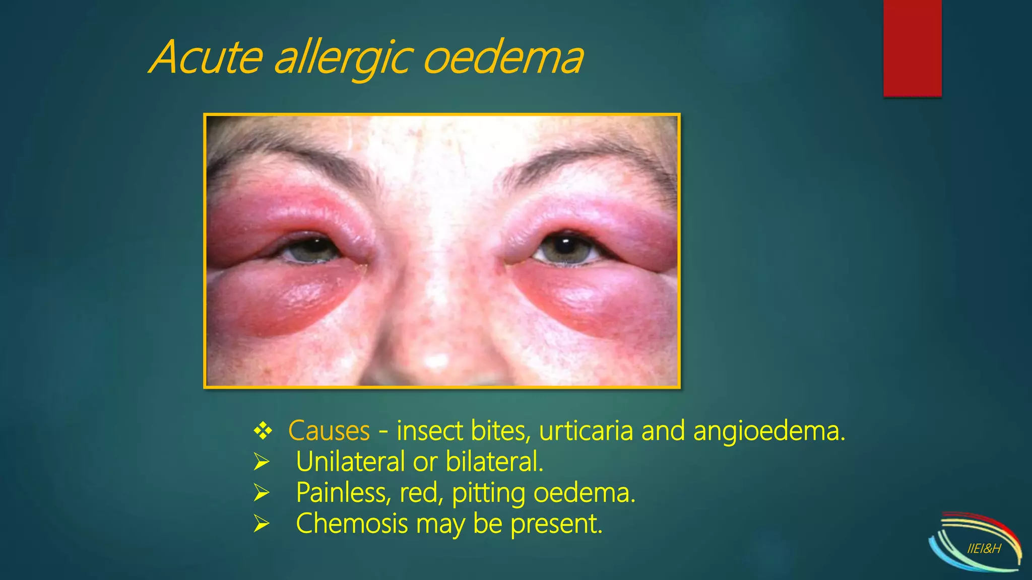 Disorders of eyelids | PPTX