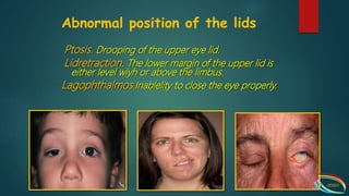 Disorders of eyelids | PPTX