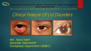 Clinical Feature Of Lid Disorders
Md . Azizul Islam
Associate Optometrist
Oculoplasty Department ( IIEI&H )
IIEI&H
 