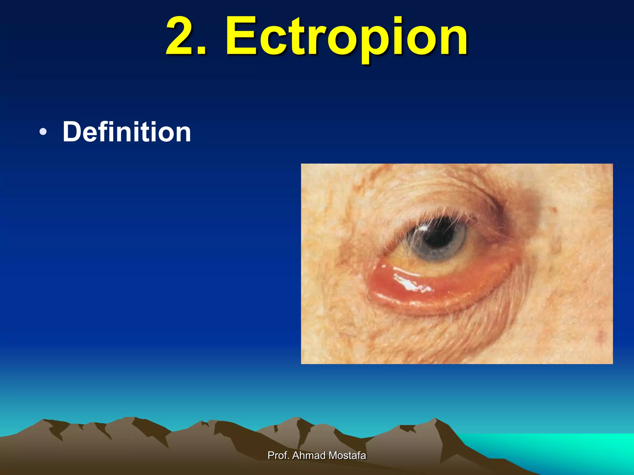 Eyelid disorders | PPT