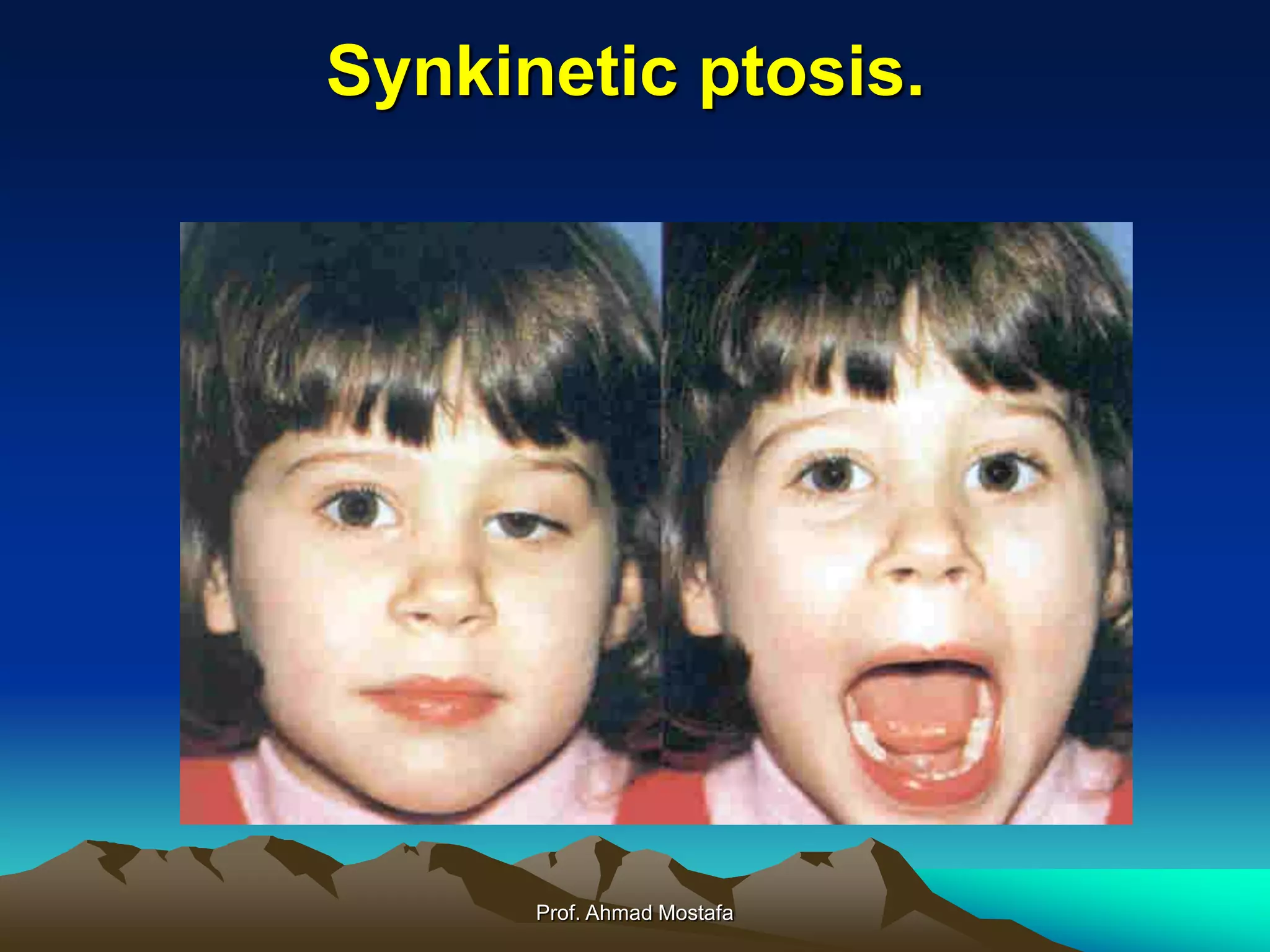 Eyelid disorders | PPT