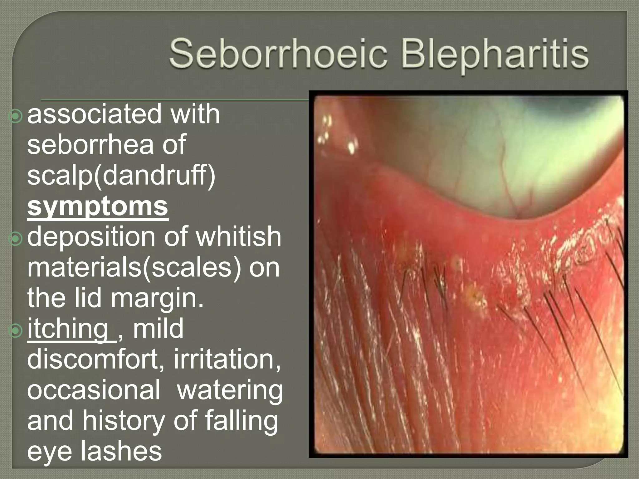 Eyelid Disorders.pptx