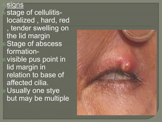 Eyelid Disorders.pptx