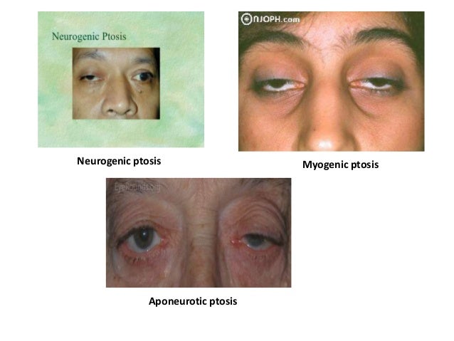 Stye Sufferer Cvs Has The Relief You Need - gwej6e7
