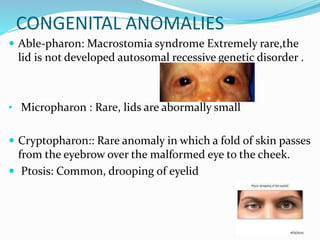 CONGENITAL ANOMALIES
 Able-pharon: Macrostomia syndrome Extremely rare,the
lid is not developed autosomal recessive genetic disorder .
• Micropharon : Rare, lids are abormally small
 Cryptopharon:: Rare anomaly in which a fold of skin passes
from the eyebrow over the malformed eye to the cheek.
 Ptosis: Common, drooping of eyelid
 