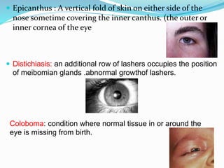  Epicanthus : A vertical fold of skin on either side of the
nose sometime covering the inner canthus. (the outer or
inner cornea of the eye
 Distichiasis: an additional row of lashers occupies the position
of meibomian glands .abnormal growthof lashers.
Coloboma: condition where normal tissue in or around the
eye is missing from birth.
 