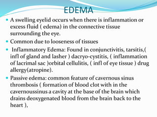EDEMA
 A swelling eyelid occurs when there is inflammation or
excess fluid ( edema) in the connective tissue
surrounding the eye.
 Common due to looseness of tissues
 Inflammatory Edema: Found in conjunctivitis, tarsitis,(
infl of gland and lasher ) dacryo-cystitis, ( inflammation
of lacrimal sac )orbital cellulitis, ( infl of eye tissue ) drug
allergy(atropine).
 Passive edema: common feature of cavernous sinus
thrombosis ( formation of blood clot with in the
cavernoussinus a cavity at the base of the brain which
drains deoxygenated blood from the brain back to the
heart ),
 