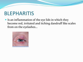 BLEPHARITIS
 Is an inflammation of the eye lids in which they
become red, irritated and itching dandruff like scales
from on the eyelashes…
 