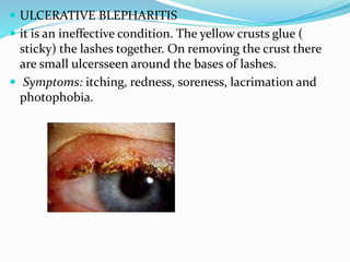  ULCERATIVE BLEPHARITIS
 it is an ineffective condition. The yellow crusts glue (
sticky) the lashes together. On removing the crust there
are small ulcersseen around the bases of lashes.
 Symptoms: itching, redness, soreness, lacrimation and
photophobia.
 
