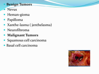  Benign Tumors
 Nevus
 Heman-gioma
 Papilloma
 Xanthe-lasma ( jenthelasma)
 Neurofibroma
 Malignant Tumors
 Squamous cell carcinoma
 Basal cell carcinoma
 