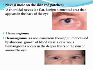  Nevus( mole on the skin red patches)
 A choroidal nevus is a flat, benign pigmented area that
appears in the back of the eye
 Heman-gioma
 Hemangioma is a non-cancerous (benign) tumor caused
by abnormal growth of blood vessels. cavernous
hemangioma occurs in the deeper layers of the skin or
aroundthe eye.
 