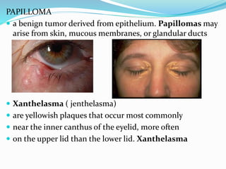 PAPILLOMA
 a benign tumor derived from epithelium. Papillomas may
arise from skin, mucous membranes, or glandular ducts
 Xanthelasma ( jenthelasma)
 are yellowish plaques that occur most commonly
 near the inner canthus of the eyelid, more often
 on the upper lid than the lower lid. Xanthelasma
 