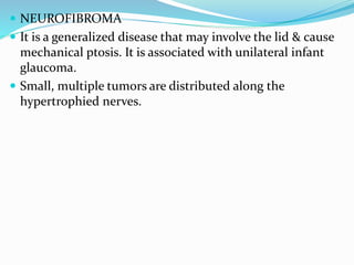  NEUROFIBROMA
 It is a generalized disease that may involve the lid & cause
mechanical ptosis. It is associated with unilateral infant
glaucoma.
 Small, multiple tumors are distributed along the
hypertrophied nerves.
 