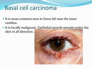 Basal cell carcinoma
 It is most common seen in lower lid near the inner
canthus.
 It is locally malignant. Epithelial growth spreads under the
skin in all direction .
 