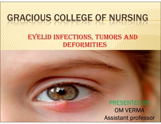 GRACIOUS COLLEGE OF NURSING
EYELID INFECTIONS, TUMORS AND
DEFORMITIES
PRESENTED BY
OM VERMA
Assistant professor
 