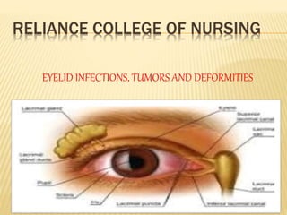 RELIANCE COLLEGE OF NURSING
EYELID INFECTIONS, TUMORS AND DEFORMITIES
 