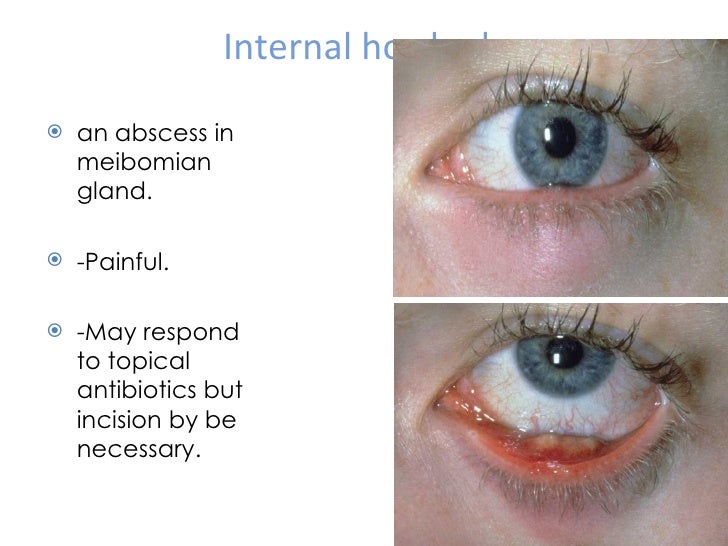 Eyelid inflammation & tumors