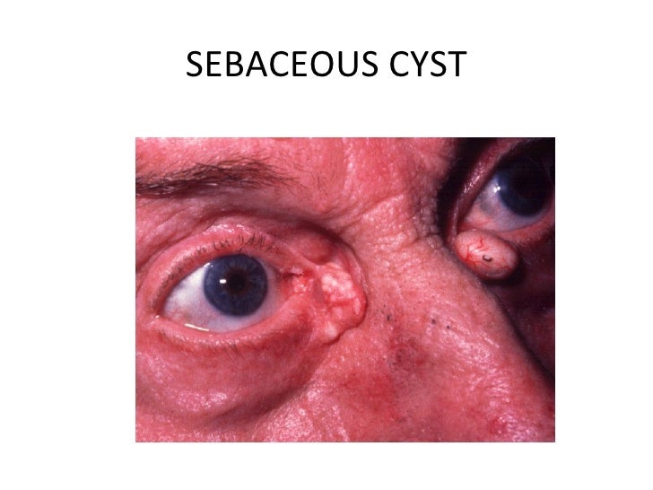 Eyelid inflammation & tumors